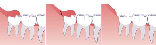 Иссечение капюшона зуба.jpg